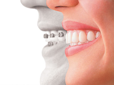 The image shows a split-screen comparison between a person s natural teeth and their teeth after dental braces treatment, with one side of the face displaying a smile before orthodontic care and the other side showing a straightened smile after treatment.