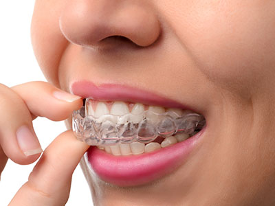 The image features a person wearing clear braces with a smile, showing their teeth and gums.
