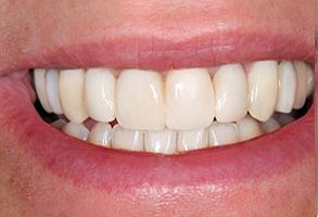 The image shows a close-up of a person s smiling mouth with teeth, revealing a smile with white fillings.