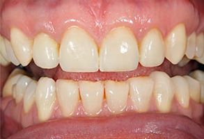 The image displays a close-up view of a person s teeth with noticeable yellowing and staining, indicating poor dental hygiene or potential oral health issues.