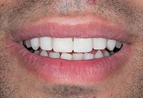 The image shows a close-up of a person s smiling mouth with white teeth and lips, against a neutral background.