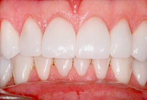 The image displays a close-up of a person s teeth with a focus on their lower front teeth, which are white and appear to be well-maintained.