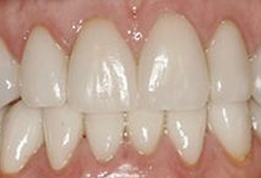 The image shows a close-up view of a person s teeth, revealing a cosmetic dental procedure with visible braces and an altered tooth structure, which could be due to orthodontic treatment or restoration work.