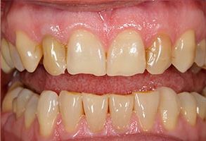 The image shows two photographs side by side, both depicting a set of human teeth with significant discoloration and decay.