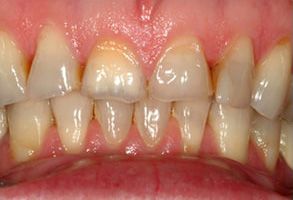 The image shows a close-up view of a person s teeth with discoloration and decay, emphasizing the need for dental care.